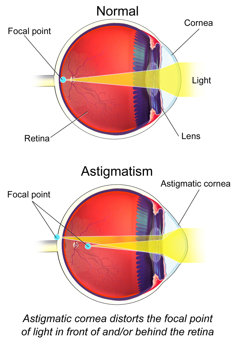 Astigmatism Lansdowne, PA